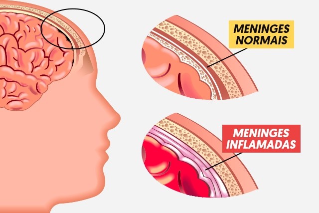 Meningite Meningocócica Saiba Mais Sobre A Causa Sintomas E Tratamento 2714