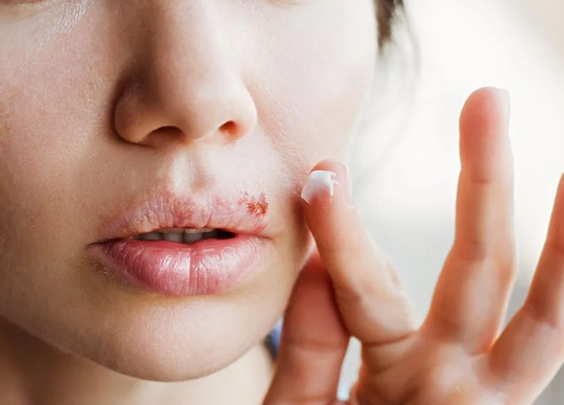 DICA DE SAÚDE Herpes labial o que é sintomas causas e tratamento